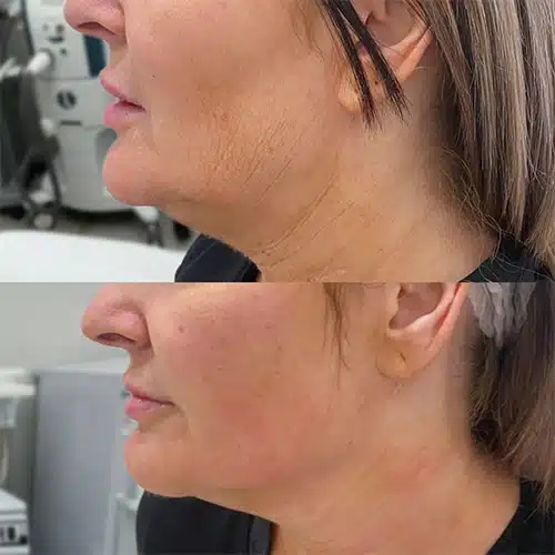 ultrasonic-befaft-3.jpg